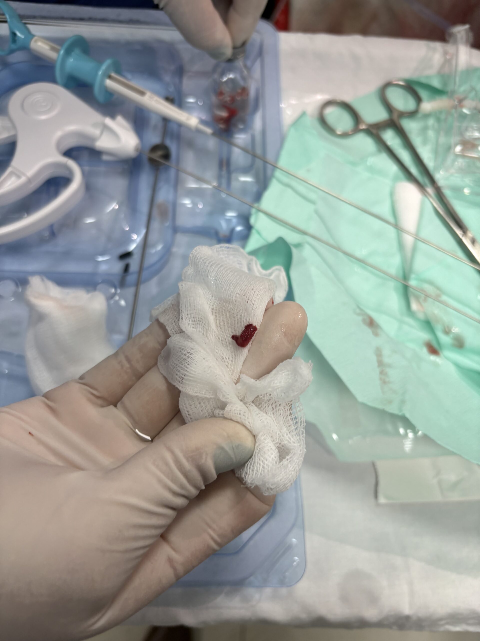 Procedimiento de histeroscopia con el sistema ARMI