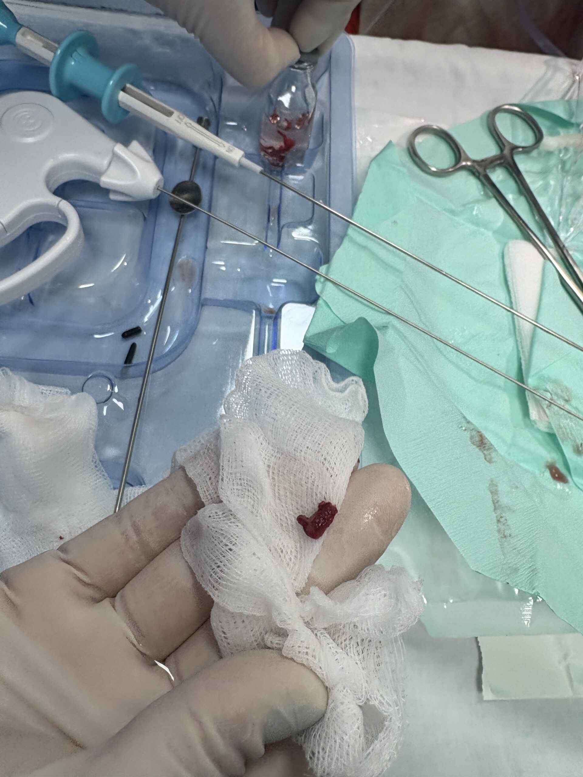 Procedimiento de histeroscopia con el sistema ARMI