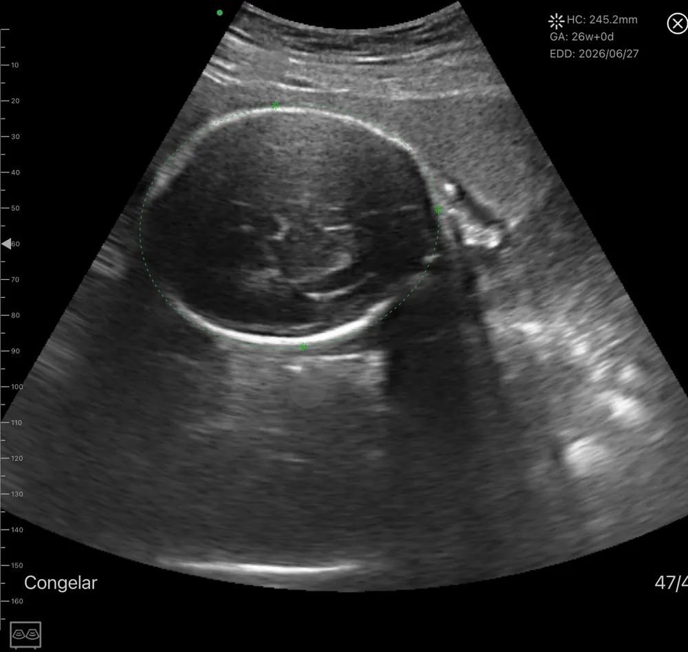 Ecógrafo ginecológico de mano KONTED C10QT, 2 en 1 Imagen ecográfica de cabeza fetal con el ecógrafo KONTED C10QT